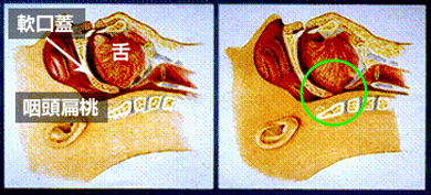 SASの原因のイラスト画像